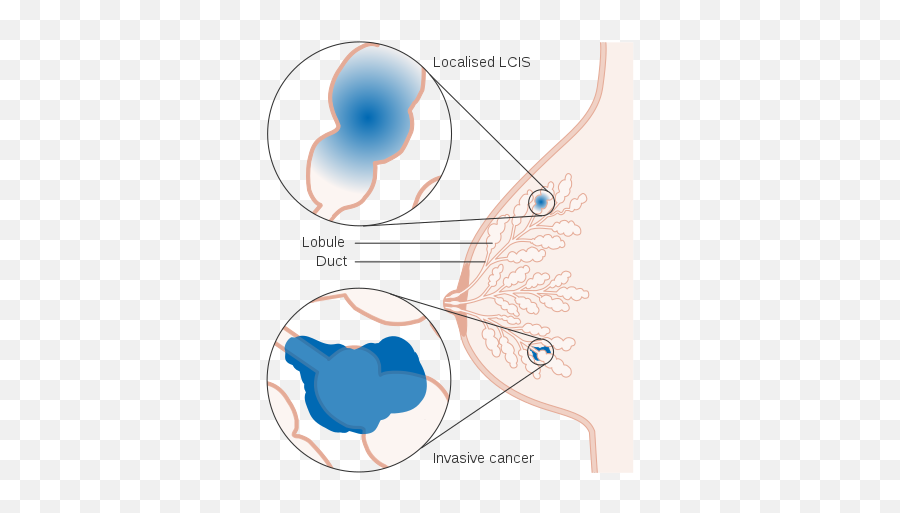 Lobular Carcinoma In Situ Owlapps - Lobular Carcinoma In Situ Emoji,Mitosis In Emojis