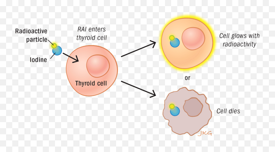 Low Iodine Diet U2023 Thanc Guide - Radioactive Iodine Therapy Emoji,Emotion Code Questions For Thyroid