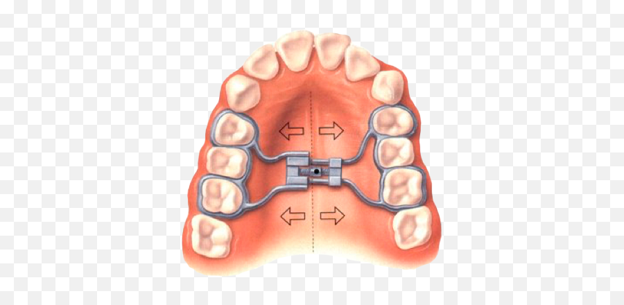 Ortopedia Dentomaxilar - Odontiyc Emoji,Emoticon Mordiendo Los Labios