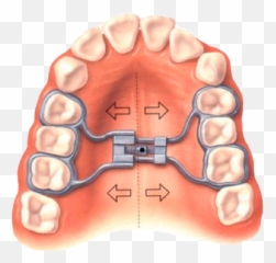 Ortopedia Dentomaxilar - Odontiyc Emoji,Emoticon Mordiendo Los Labios