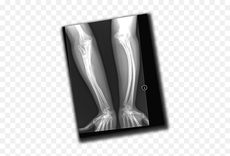 Osteogenesis Imperfecta - Arm Of Osteogenesis Imperfecta Emoji,Arobic Emoji Osteogenesis Imperfecta - Arm Of Osteogenesis Imperfecta Emoji,Arobic Emoji