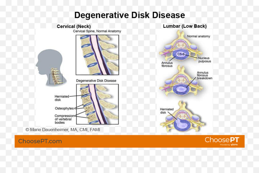 Guide Physical Therapy Guide To Degenerative Disk Disease Emoji,Your Spine Stores Your Emotions