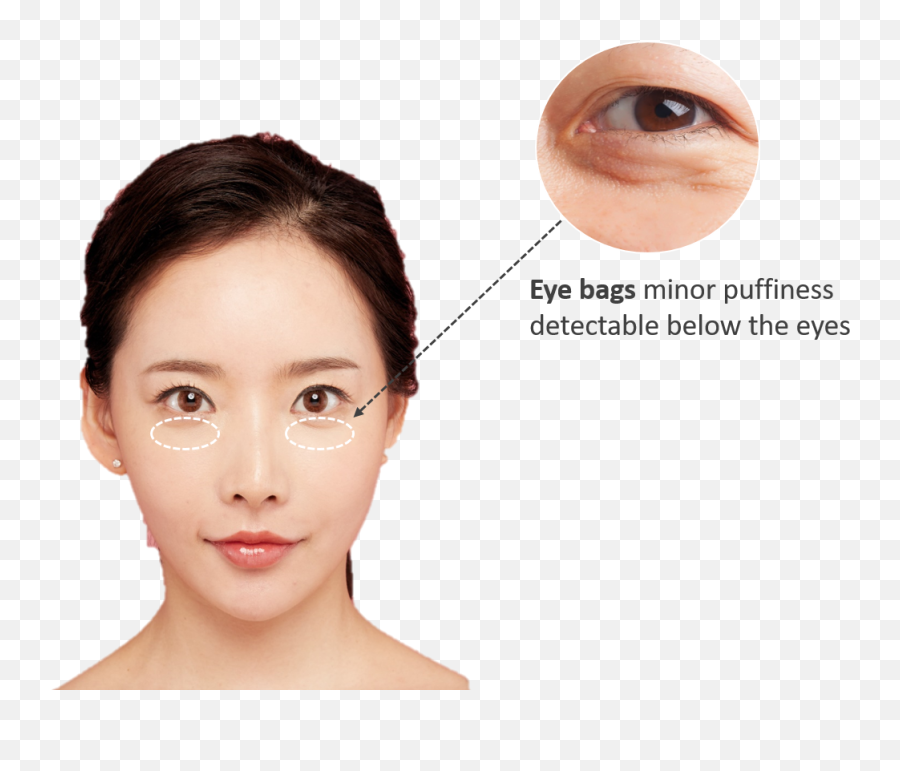 Best Dermal Fillers Eye Bag Removal Emoji,Eye Bag Emoticon