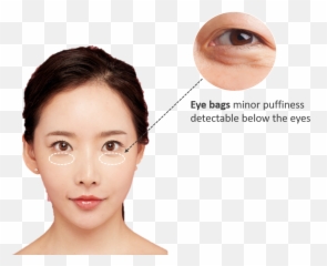 Best Dermal Fillers Eye Bag Removal Emoji,Eye Bag Emoticon