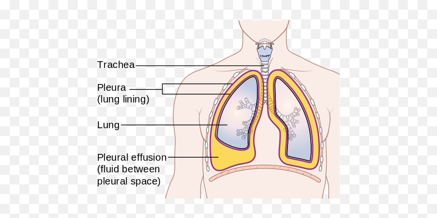 Pleural Effusion - Pleural Space Emoji,Effusion Lamp Emotion Momente