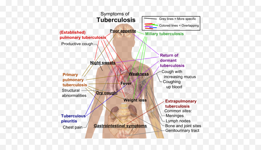 Tuberculosis - Tuberculosis Vs Pneumonia Emoji,Medscape Mayo Clinic Emojis