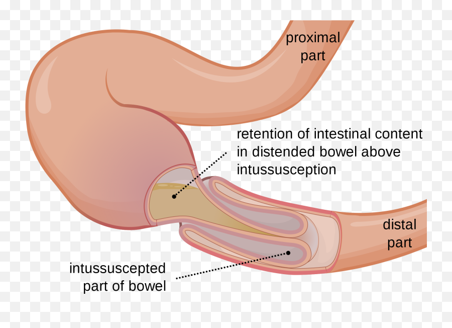 Diagnosis And Treatment Christopher P Coppola Alfred P - Intussusception Dog Emoji,Emotions Outline Wiki