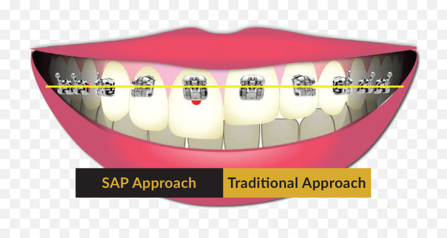 The Art Of Braces - Smile Arc Protection The Art Of Braces Emoji,Meaning Of Tooth 32 And Emotions