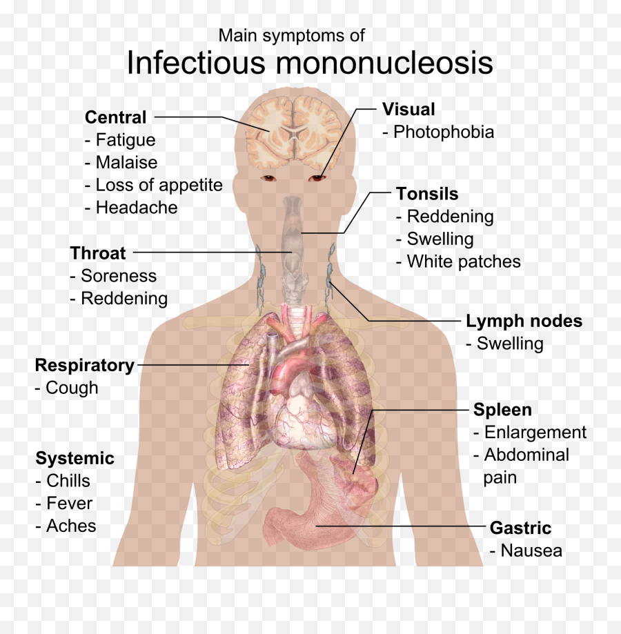 Epstein Barr Virus Article - Infectious Mononucleosis Symptoms Emoji,Emotions Spleen Pancreas