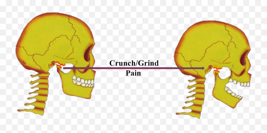 Tmdtmj Disorders Harkins Pain U0026 Sleep Management Group - Jaw Subluxation Emoji,Tucson Harkins Emojis