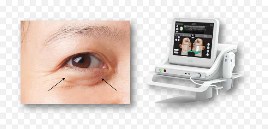 Eye Filler Malaysia Best Dermal Fillers U0026 Eye Bag Removal Emoji,Eye Bag Emoticon