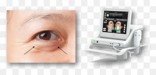 Eye Filler Malaysia Best Dermal Fillers U0026 Eye Bag Removal Emoji,Eye Bag Emoticon