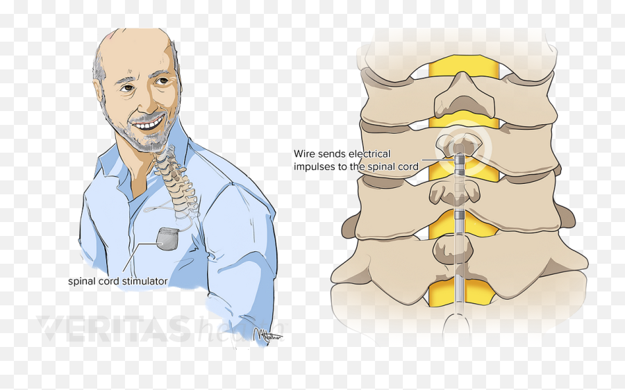 Spinal Cord Stimulators And Pain Pumps - Intrathecal Pump Emoji,What Emotion Is Connected To Lower Back Pain