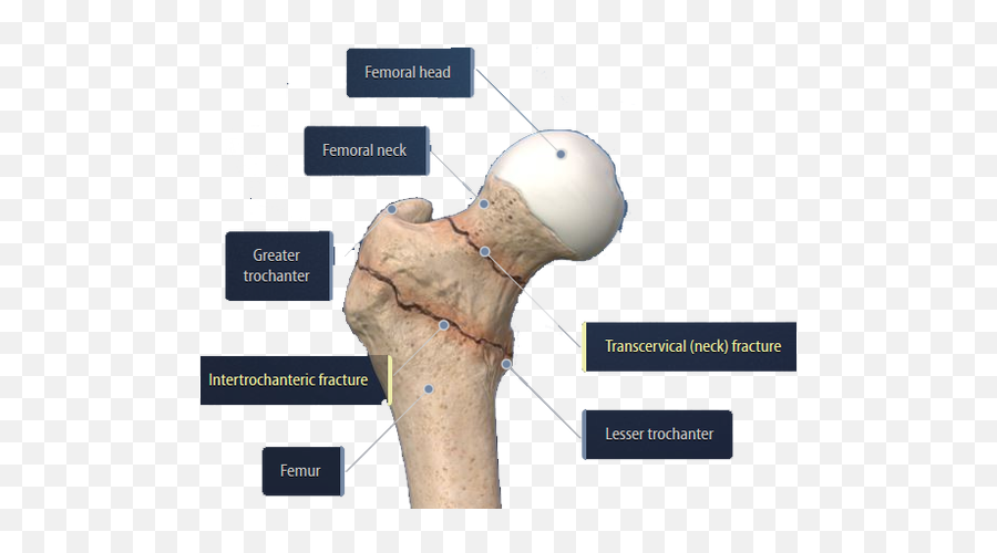 Hip Fracture Center - Language Emoji,Emotion And Intertrochanteric Fracture