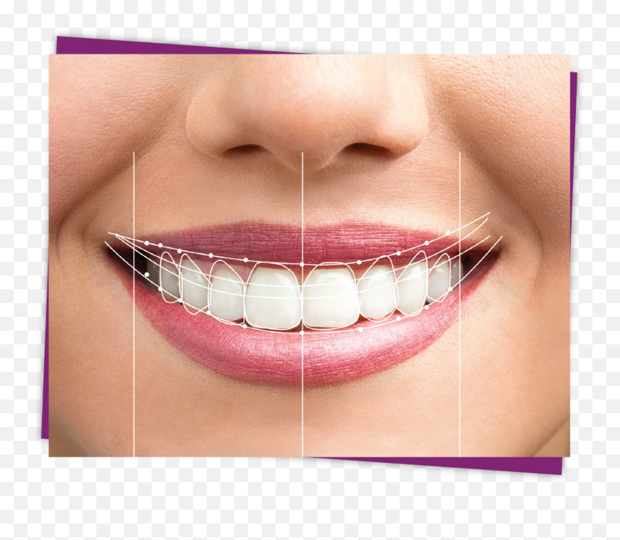 Smile Design - 2020 Digital Smile Design Emoji,Mouth Emotions Reference Lips