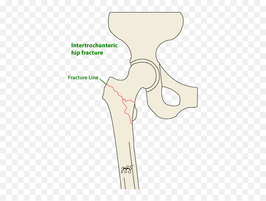 Hip Fractures - Dot Emoji,Emotion And Intertrochanteric Fracture