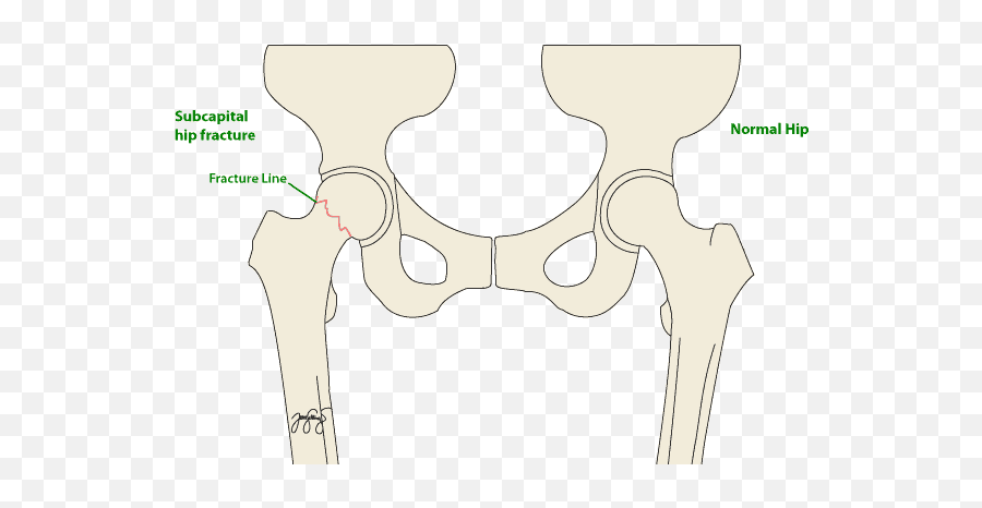 Hip Fractures - Fracture Of Hip Label Emoji,Emotion And Intertrochanteric Fracture
