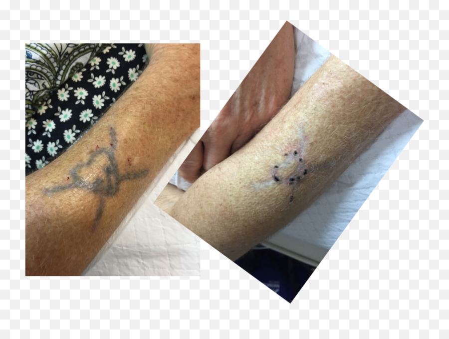 Laser Free Tattoo Removal - Clinical Skin Temporary Tattoo Emoji,Regret Is A Wasted Emotion Tattoo