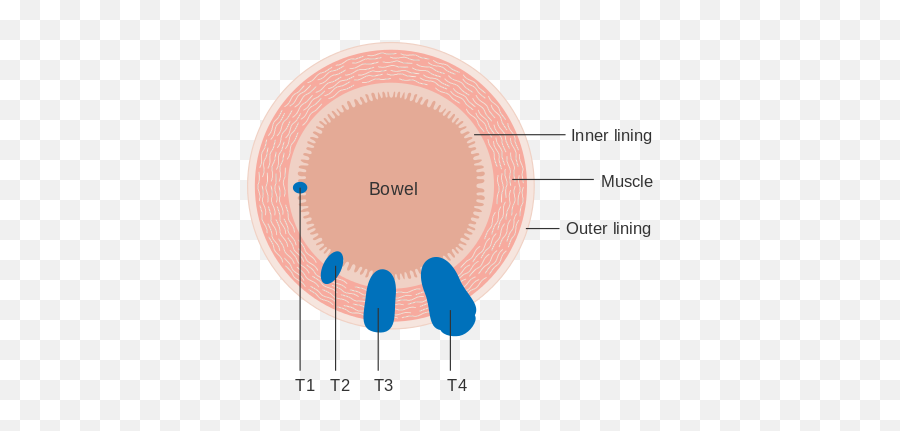 What Is T1 Colon Cancer - T Staging Colon Cancer Emoji,What Does 