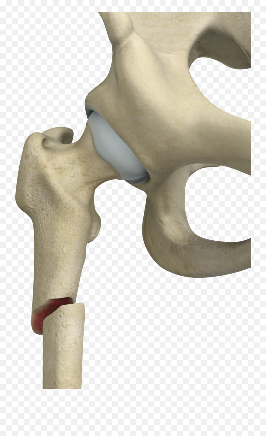 Subtrochanteric Hip Fracture Treatment Emoji,Emotion And Intertrochanteric Fracture