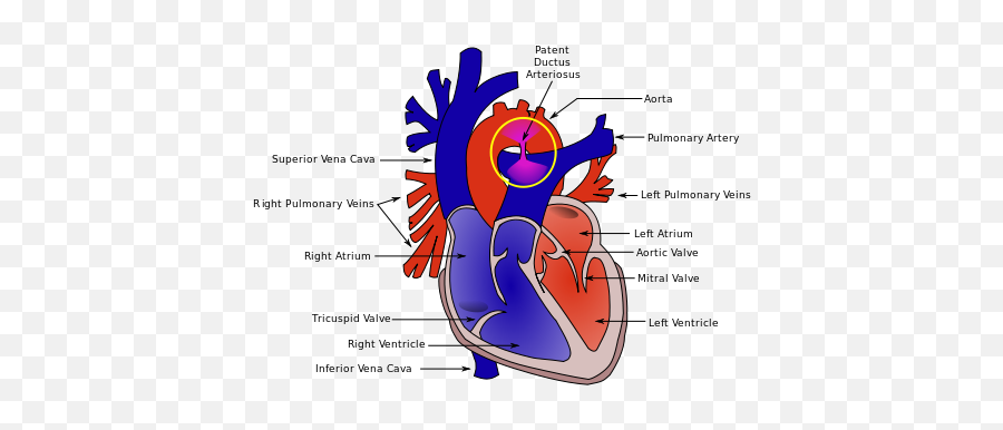 Terjual Pengenalan Tentang Penyakit Jantung Bawaan - Patent Ductus Arteriosus Emoji,Emoticon Parman