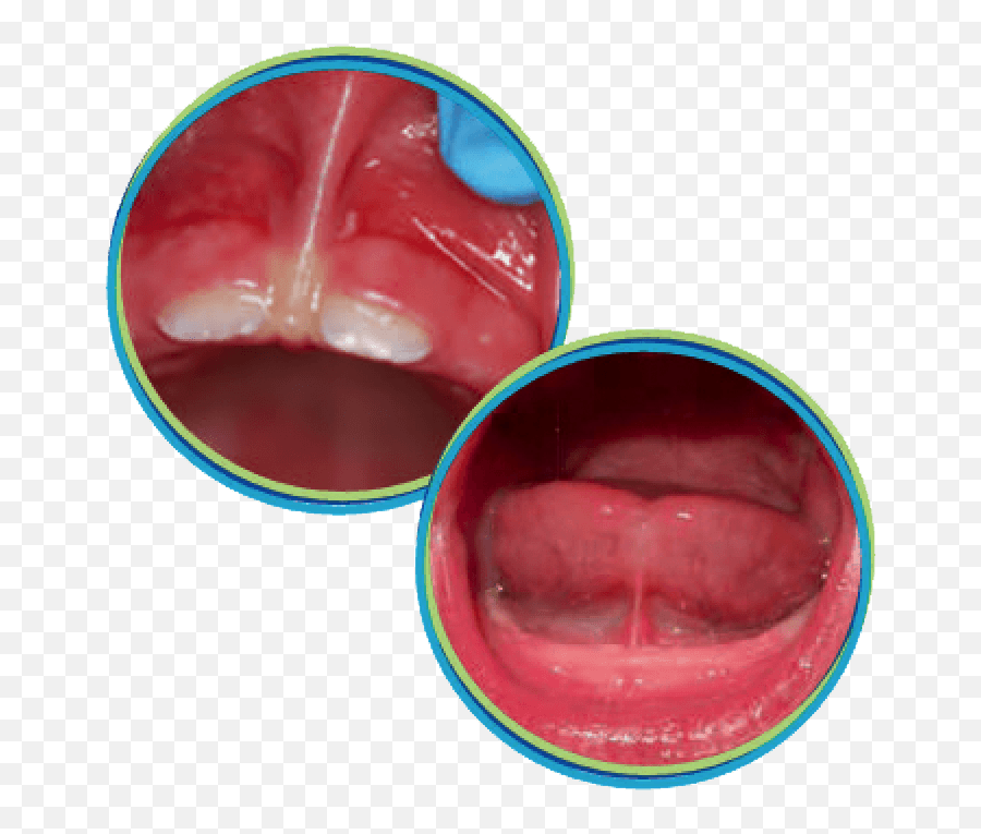 Dentist In Trenton Tongue And Lip Ties Riverside Dental - Lip Tie Laser Emoji,Emotion Of Parsed Lips