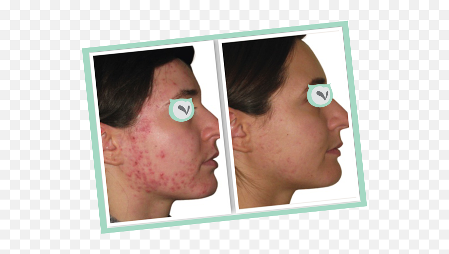 Skinwise Rx Beauty Blog - Accumax Skin Before And After Emoji,Homeopathic Reasons Face Breakout And Emotions