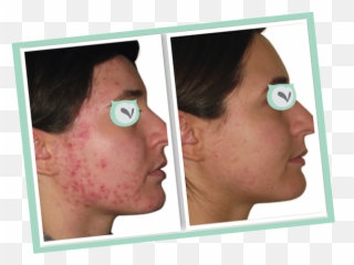 Skinwise Rx Beauty Blog - Accumax Skin Before And After Emoji,Homeopathic Reasons Face Breakout And Emotions