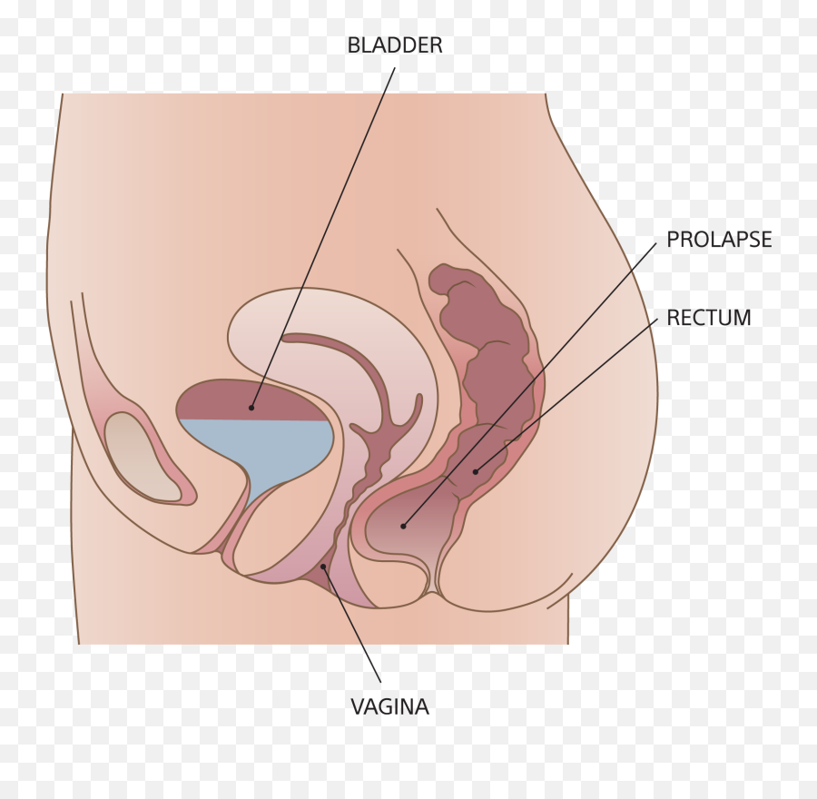 Pelvic Organ Prolapse Diagnosis - Chooseyoucom Retocele E Cistocele Emoji,Emoji For Pelvis