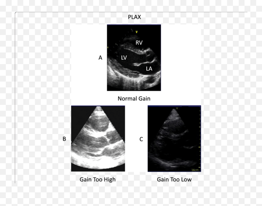 The Parasternal Long Axis View - Pulmonary Stenosis Plax View Emoji,Emover Emotion