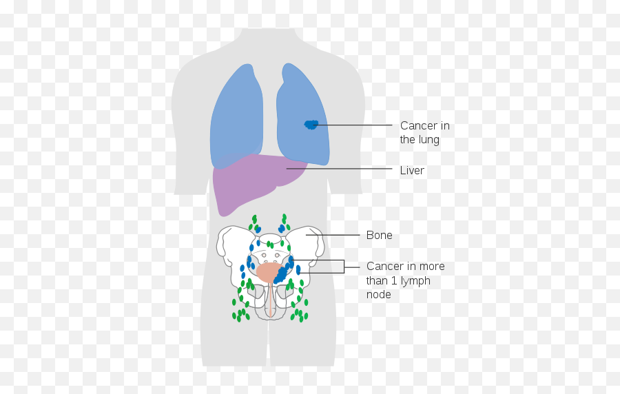 Bladder Cancer - Tcc Metastasis Emoji,Sayer Ji On Emotion And Bladder