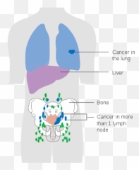 Bladder Cancer - Tcc Metastasis Emoji,Sayer Ji On Emotion And Bladder