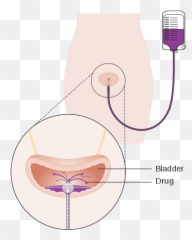 Bladder Cancer - Vertical Emoji,Sayer Ji On Emotion And Bladder