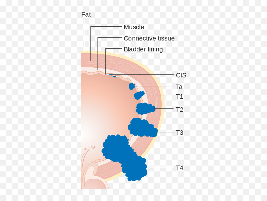 Bladder Cancer - Muscle Invasive Bladder Cancer Stage Emoji,Sayer Ji On Emotion And Bladder