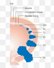 Bladder Cancer - Muscle Invasive Bladder Cancer Stage Emoji,Sayer Ji On Emotion And Bladder