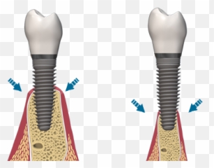 Bone Loss Due To Gum Disease Emoji,Different Bone Emojis