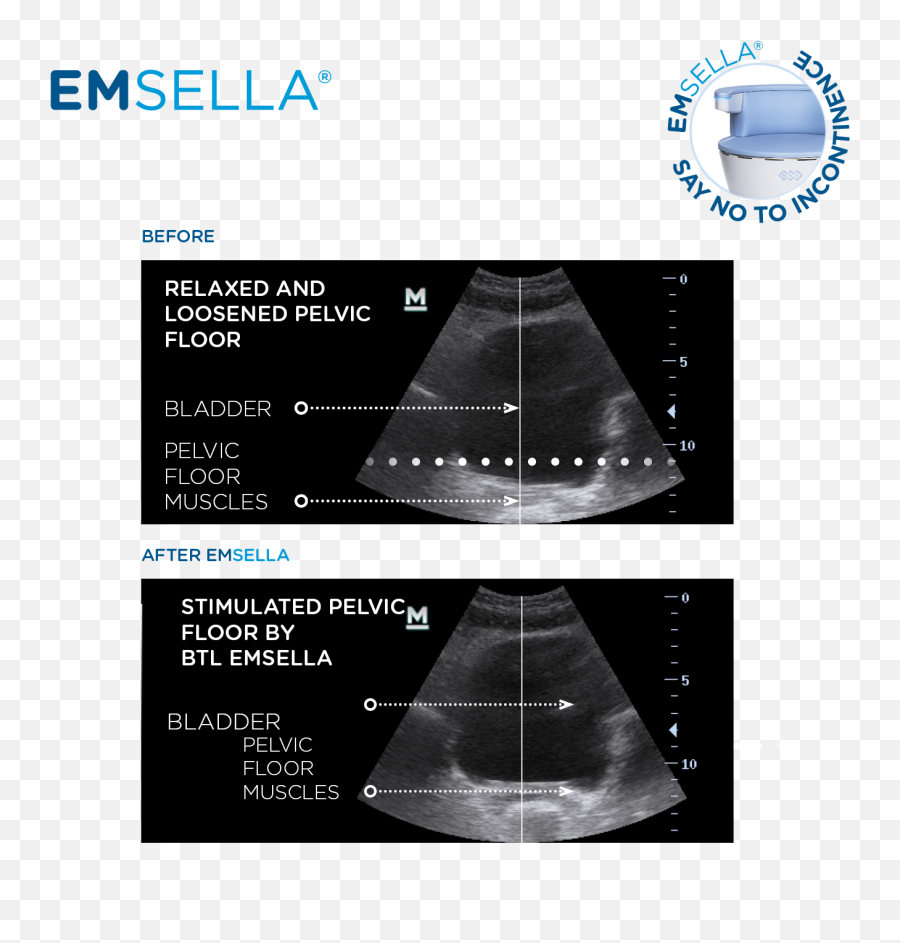 Acne Treatment U2014 Emsella U2014 Rejuve Medspa U2014 Rejuve Medspa Emoji,How To Make Left Muscle Arm Emoji Acne Treatment U2014 Emsella U2014 Rejuve Medspa U2014 Rejuve Medspa Emoji,How To Make Left Muscle Arm Emoji