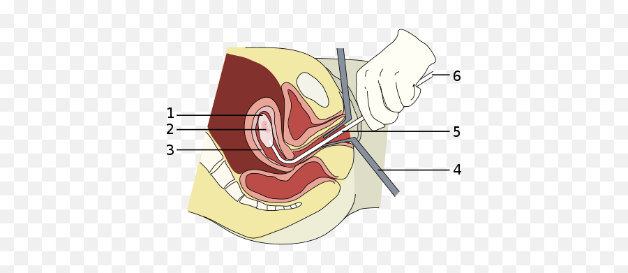 Abortion - Wikiwand Alat Kuret Kandungan Emoji,Teenage Emotions Wiki