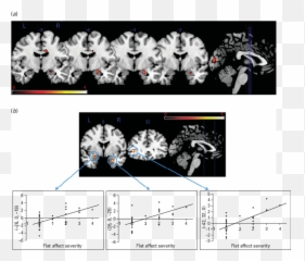 Conjunction Analysis Showing Amygdala - Language Emoji,Lines Representing Emotions