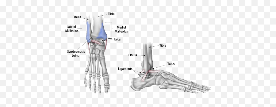 Ankle Fractures - Lateral Malleolus Emoji,Emotion And Intertrochanteric Fracture