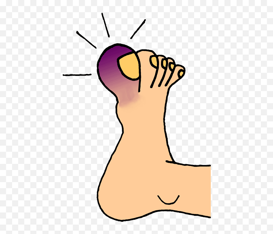 Broken Toe - Toe Clip Art Emoji,Broken Leg Emoji