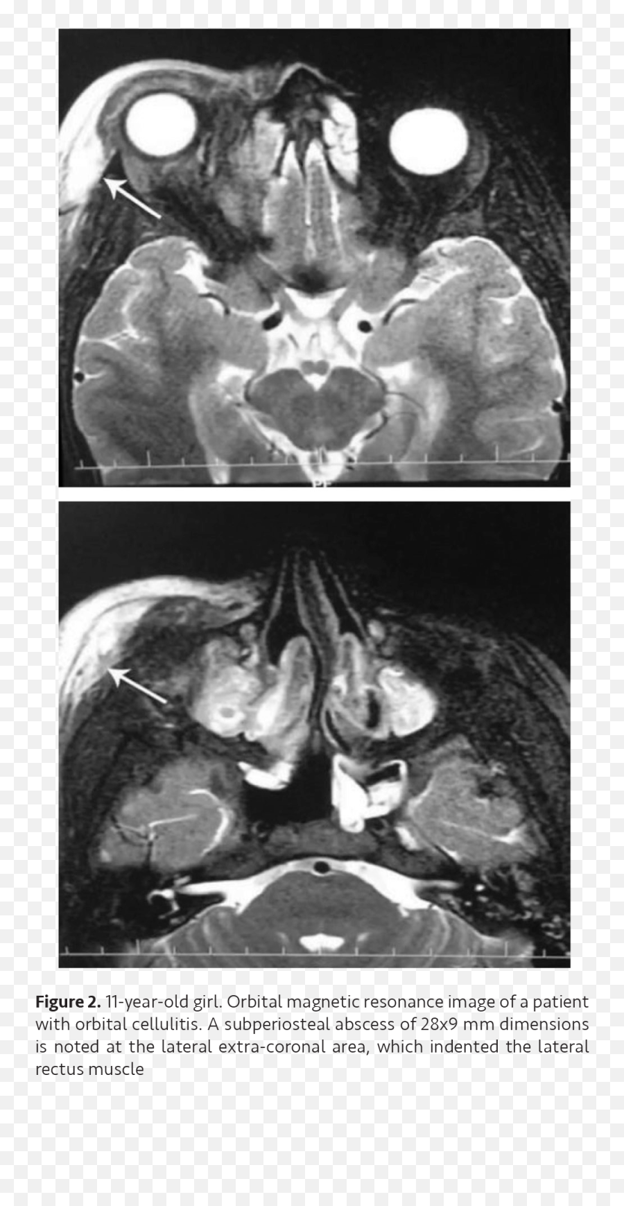 Orbital Cellulitis Complications - Computed Tomography Emoji,Mucocele Emoji Orbital Cellulitis Complications - Computed Tomography Emoji,Mucocele Emoji