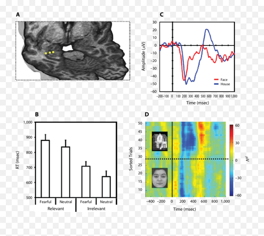 A Left Back And Top View Of The Patientu0027s Brain T1 Mri Emoji,Mri Of The Brain With Different Emotions And Thought