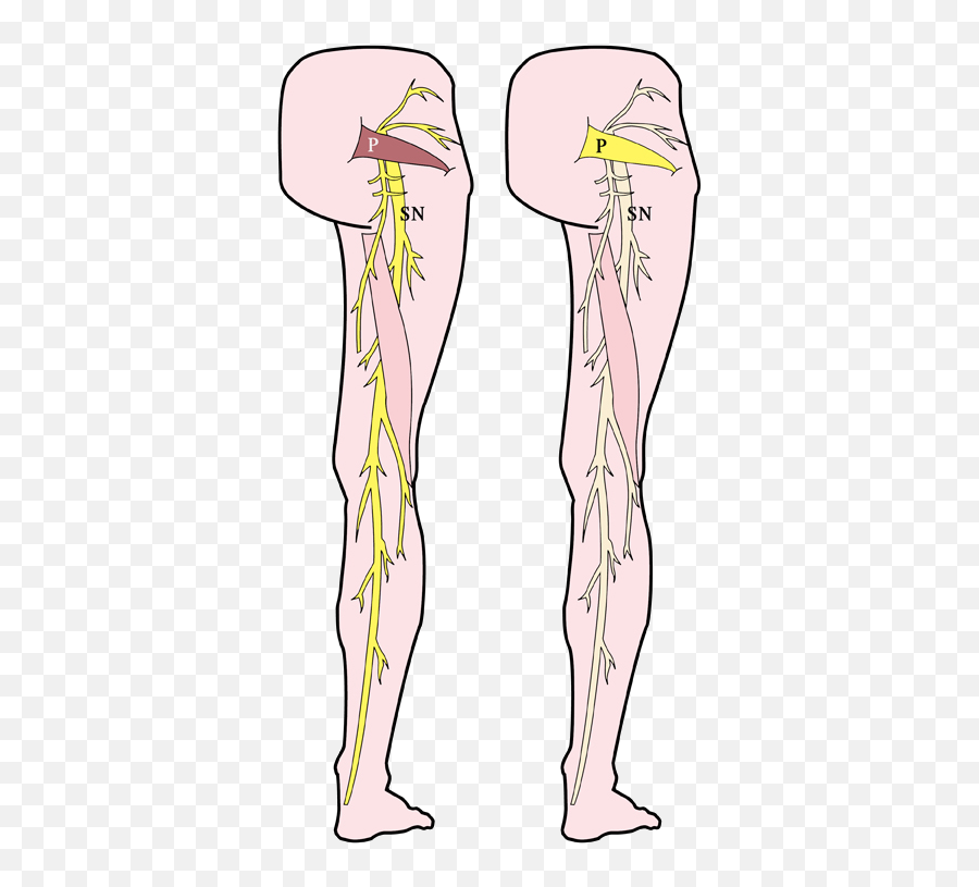 Why Do We Get Sciatica And Piriformis Syndrome - Psoas Sciatica Emoji,30 Muscles For Emotion