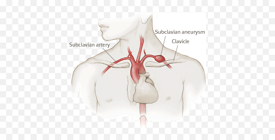 Subclavian Aneurysm Emoji,Tender Collarbone Chest Emotions