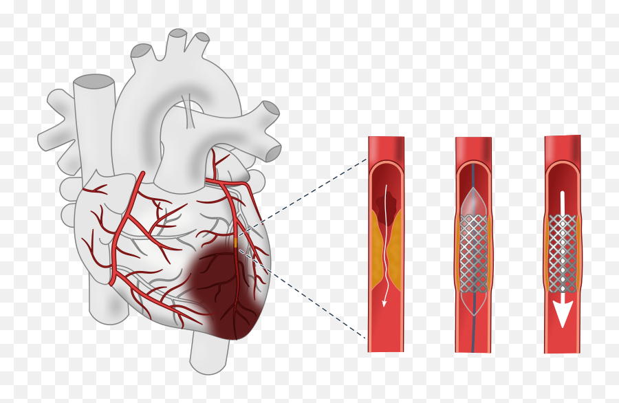 Myocardial Infarction Wiki Thereaderwiki - Myocardial In Fraction Emoji,Effusion Lamp Emotion Momente