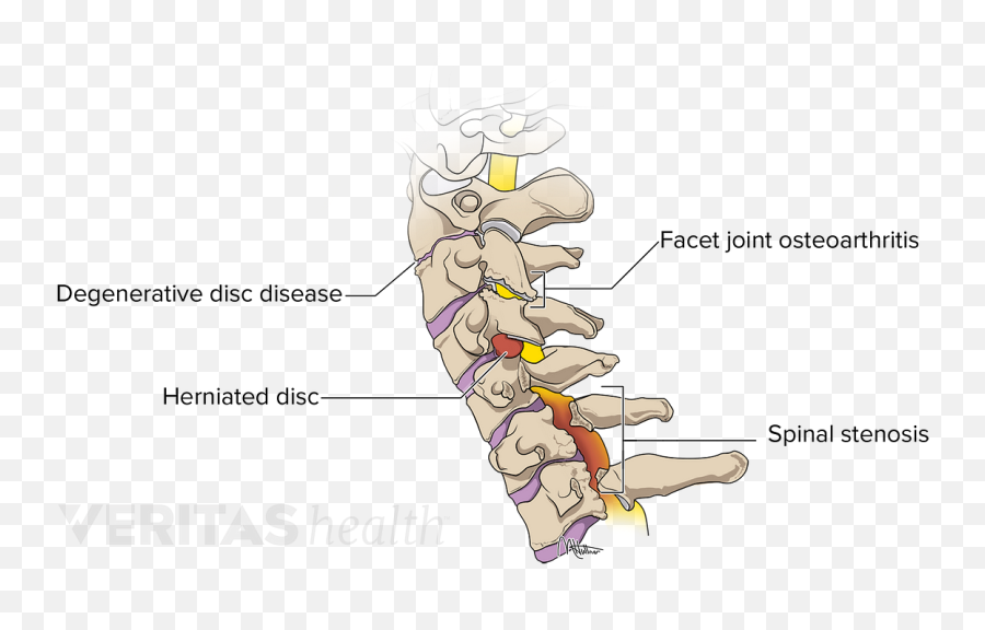 How Cervical Degenerative Disc Disease Causes Pain And Other - Step Neck Emoji,What Emotion Is Connected To Lower Back Pain