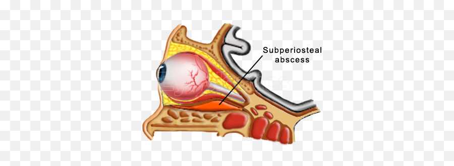 Orbital Cellulitis Complications - Subperiosteal Abscess Eye Emoji,Mucocele Emoji