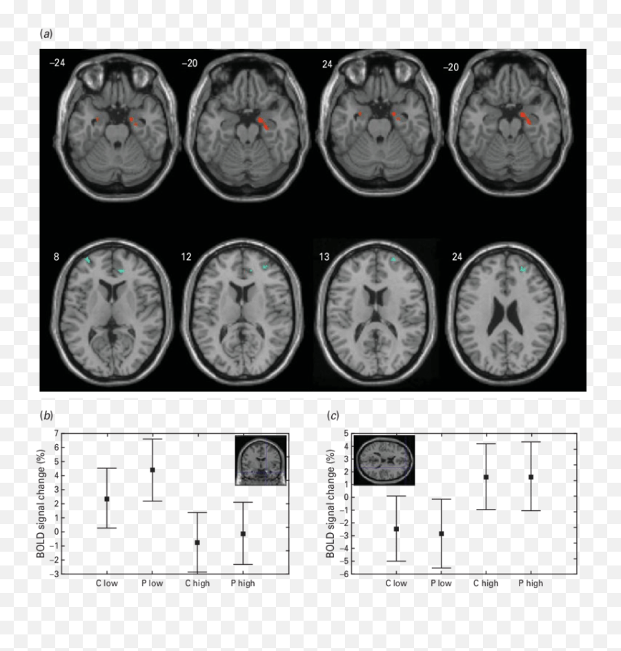 Grey Matter Areas Showing A Significant - Amygdala Changes Due To Aces Emoji,Mri Brain Scan Tumor Emotion