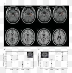 Grey Matter Areas Showing A Significant - Amygdala Changes Due To Aces Emoji,Mri Brain Scan Tumor Emotion